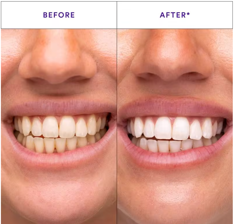 Radiant Whitening & Ultra-Effective Care for Sensitive Teeth