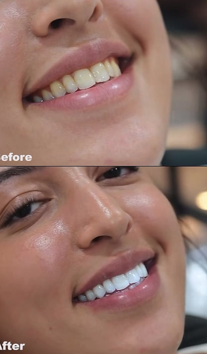 "Sensitive Teeth Immediate Effect" Whitening Kit, 90 days, #1⭐️🏅